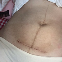 今天刨腹产36天了，可是伤口还痛，用手碰会痛，裤子穿紧一点的勒到也会痛，有没有刨腹产的妈咪请教下，...