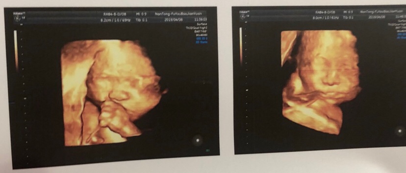 做的四维
有没有同款在肚子里吃手的宝宝😄