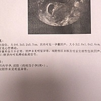 昨天去检查了，有谁会从孕囊看男女的？