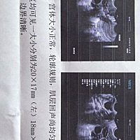 促排2个优势卵泡，也很顺利的排出了！能是双胞胎吗？概率大不！很好奇呐