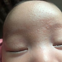 这是湿疹还是痱子还是过敏，问了几个大人，个总答案都有。鼻子，耳后额头，头顶都有，脖子那个图片是白...