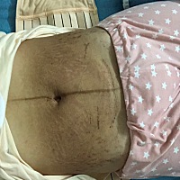 为什么生完之后肚子中间这块这么黑？以后会恢复正常吗？