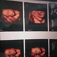 二宝的三维彩超  都说像大宝