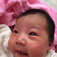 大家帮忙看一下是湿疹吗，耳朵鼻子上都是，现在穿的也不多。应该怎么办？