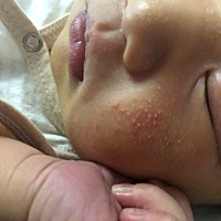 宝妈们，跪求去湿疹的方法。医院开的药没效果