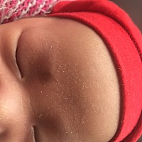 橄榄油用了两天额头上的奶痂皮好很多了