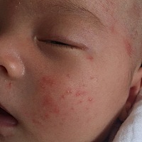 宝宝刚满月脸上全身出了好多痱子、只穿一件薄上衣还是这样、反反复复的好不全。