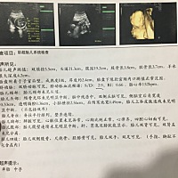 四维大排畸一次顺利通过！谢天谢地 提前了一周去医院，本来想查个血呢，因为上周和前天都又晕又吐的，怕...