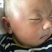 宝宝脸上长了这是湿疹吗？
