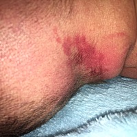 养娃之路真心累！黄疸还没退，湿疹又来了！好吧这也就算了，昨天突然发现脖子后面多了一块红红的，不知...