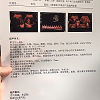 这么大的胖娃娃可以顺产吗