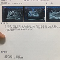 今天做了nt，能看出胎儿性别吗？