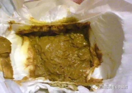 添加辅食的婴儿的标准便便