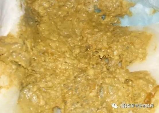 配方粉喂养的婴儿的标准便便