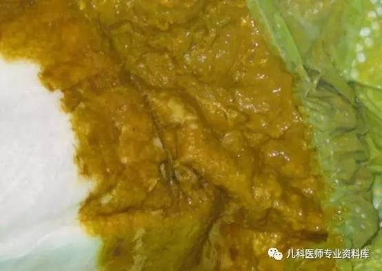标准的母乳喂养小婴儿便便