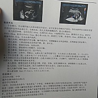 胎儿颈部水肿，右骶前位，有宝妈遇到这样的问题吗？有影响吗？我很担心…