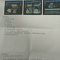 今天查了b超