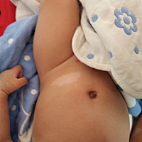 宝宝突然这里有一块白色的不知道怎么回事宝妈们知不知道这是什么