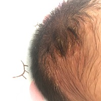 我想问下各位宝妈，宝宝剃了头发就一直想这个，用了茶油洗，洗干净又长出来，先是有点红感觉还有点水浆...