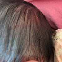 有宝妈知道头上长这种白色泡泡是怎么回事吗耳朵后面也有几个