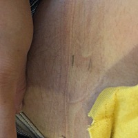 这是今天医生按摩的地方，和拔罐的地方(医生拔罐不是用火罐呢)这是医生给画的，刚回来还没去洗掉，先拍...