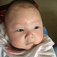 宝宝出生四十八天了，最近脸部湿疹比较严重，宝妈们有没有遇见过类似的情况，大家怎么治疗的？麻烦看到...