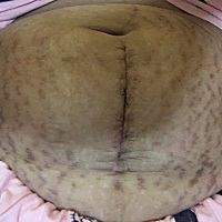 产后半个月的肚子 157的身高，孕前110，产前150，现在125 妊娠纹接受疤痕也接受就是不知道什么时候肚皮...