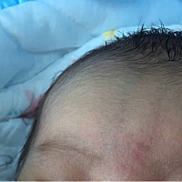 宝宝刚出生额头上就红红的一块，好担心是胎记啊，有没有相同情况的宝宝呀，每天都是玻璃心的，在做月子...