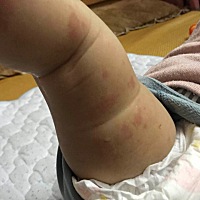 有妈妈知道这些是什么吗？？？屁股上也有