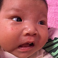 宝宝脸上起了好多红疙瘩，一小堆的长在一起，此消彼长，接连不断，有知道这种情况并知道怎么解决的吗？...