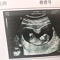 12周加5、NT顺利通过   第一次见到小宝宝的样子是不是好可爱呢！