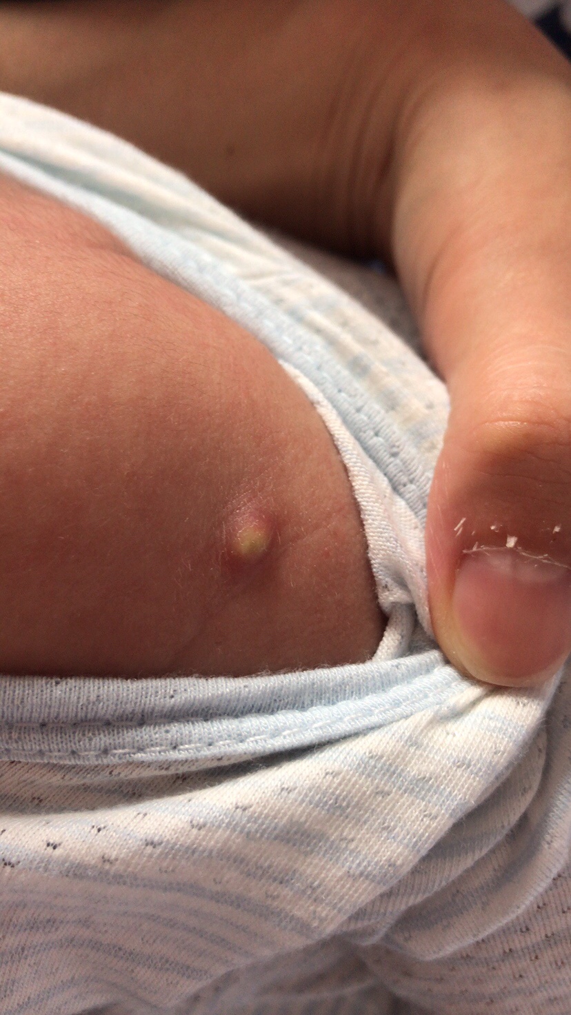 满月的预防针打了14天了 好像化脓了 有人说正常的 有这样经验的宝妈吗？微信问医生说观察啊几天！