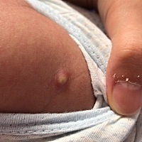 满月的预防针打了14天了 好像化脓了 有人说正常的 有这样经验的宝妈吗？微信问医生说观察啊几天！