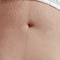 剖腹产第11天   肚子还是有点肉肉   身上几乎都消肿了  到目前为止瘦了22斤   还在以一天一斤肉的掉  �...