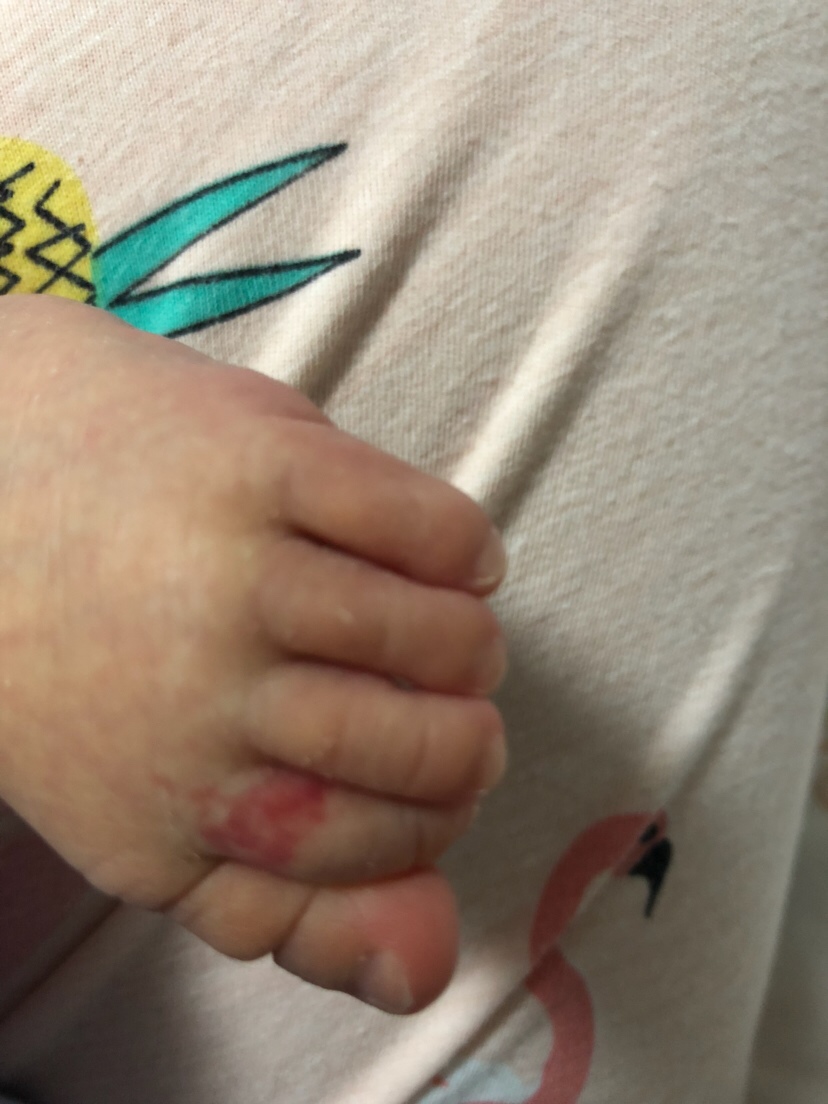 大家帮我看看。宝宝这个脚趾是什么情况。宝宝才s17天。