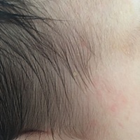 宝宝头上有小水泡，类是的东西，请这正常吗？