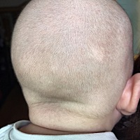 我家宝宝马上100天了，满月的时候给他剃了头发，现在发现他掉头发，照片上的掉发正常吗？