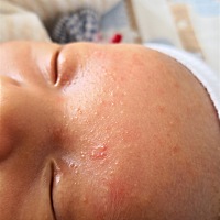 跪求各位宝妈分享去湿疹的好方法，前天涂了郁美净，昨天好像好一些了，今天早上起床更多了，头发里面都...