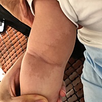 宝宝生下来。胳膊内测和腋下就有这个。这是胎记还是什么皮肤病呢？？？？