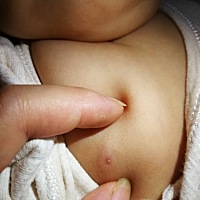 女孩子，右边乳头长了个像粉刺一样的怎么回事，以前没注意，小孩四个月了，