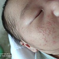 15天的宝宝脸上起了好多红痘痘，是湿疹吗？