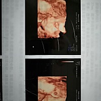 看双颈顶和股骨长感觉是女孩，这个准吗？有会看的宝妈么，纯属好奇。