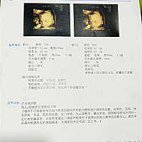 双胎医生说宝宝偏大要控制下，可是我已经吃的很少了呀。三维只有一个宝宝配合做了一个，小胖胖好可爱