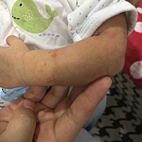 手上不知道长了什么东西？求大家支招，谢谢