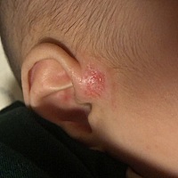 求助，我家宝宝耳边先是张了个红疙瘩，然后涂了点擦湿疹的药，本来好点的，又不知道怎么突然复发并...
