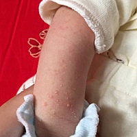 宝妈  这个是什么东西啊  宝宝身上有   头上也有一些