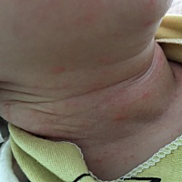 宝宝脖子以及下巴长了这些是什么各位宝妈帮忙看看呀