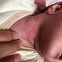 宝宝出生一个多月了、脖子这是怎么回事？