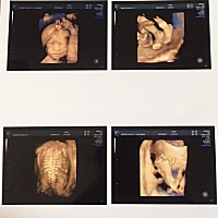 大宝女一周岁剖腹产，现在二宝也是个女孩👧，有点失落……