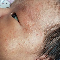 有宝妈知道这是什么吗？身上没有，脸上这个是月子25天左右开始一点点起的 今天33天了。